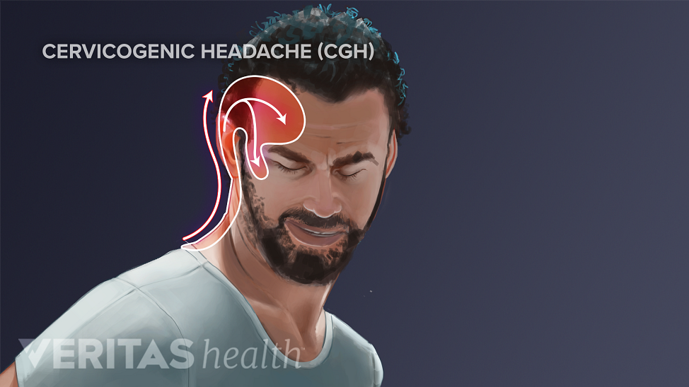 Diagram of man highlighting areas of the head and neck affected by a cervicogenic headache.