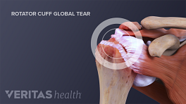 Global rotator cuff tear