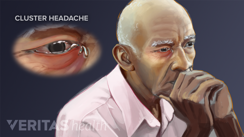 Diagram of man highlighting areas of the head and behind the eye affected by a cluster headache.