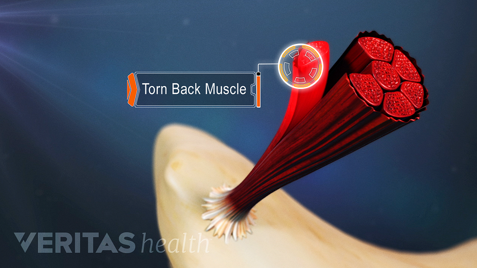 Animated video still of torn back muscle fiber