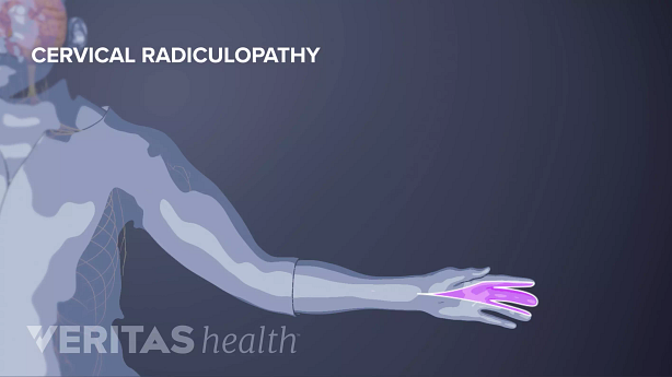 Illustration of cervical pain radiculopathy in the hand.
