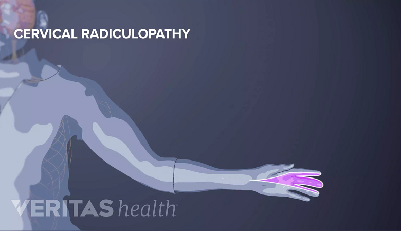 Illustration of cervical pain radiculopathy in the hand.