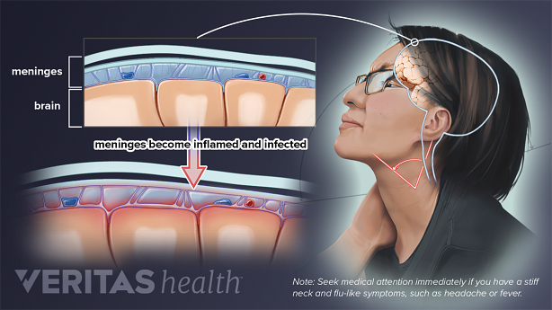Medical illustration of inflamed and infected meninges