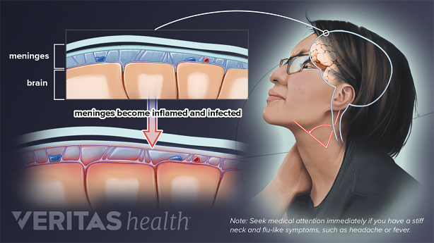 Woman with meningitis.