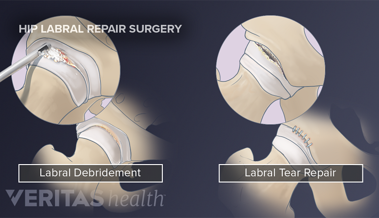 Illustration showing labral debriment and labral tear repair.