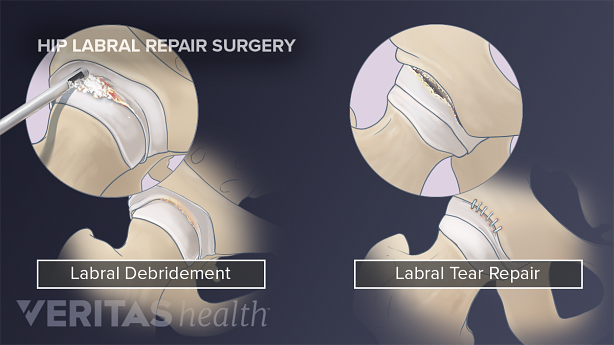 Hip labral debridement and tear repair