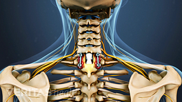 Posterior view of the cervical and thoracic spine showing spinal fusion.