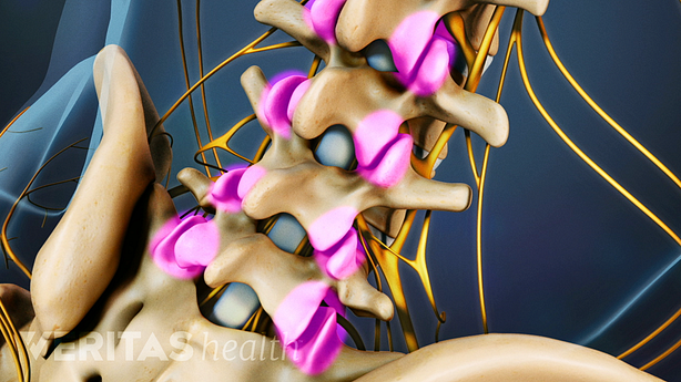An illustration of a adult spine showing facet joint highlighted in pink.