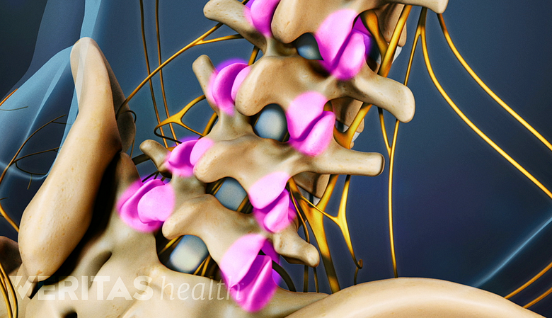An illustration of a adult spine showing facet joint highlighted in pink.