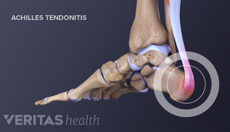 Illustration showing anatomy of feet with achilles tendonitis.