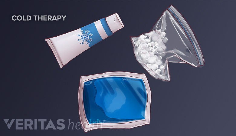 Illustration of 3 types of cold therapy items.