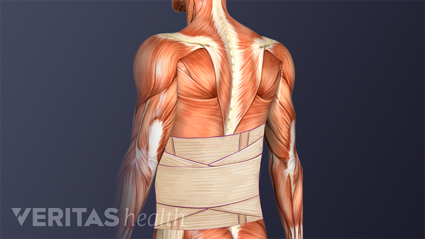 Posterior view of torso with a lumbar brace.