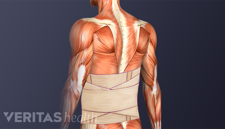 Illustration showing posterior view of lumbar brace in the lower back.