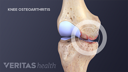 Medical illustration of inflammation in the knee joint