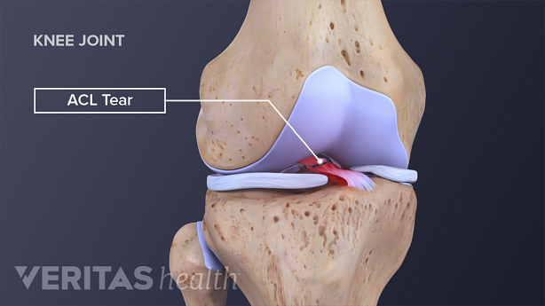 Anterior view of the knee joint labeling ACL tear