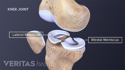 View of medial and lateral meniscus in the knee.