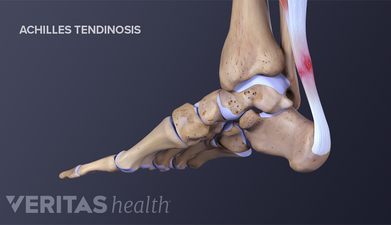 Illustration of anatomy of feet showing achilles tendinosis.