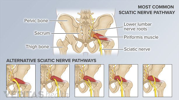 Illustration of the pelvic bone and 5 anatomical variations of the sciatic nerve.