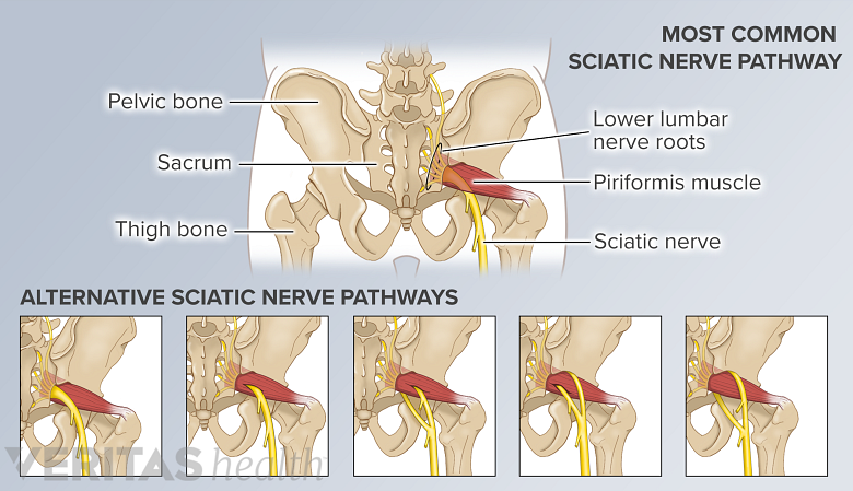 Illustration of the pelvic bone and 5 anatomical variations of the sciatic nerve.