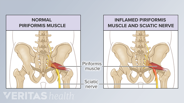 Una ilustración que muestra el músculo piriforme normal frente al inflamado.