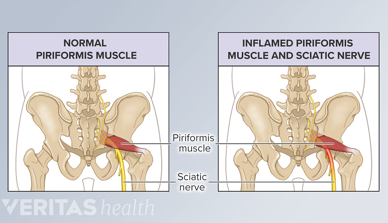Una ilustración que muestra el músculo piriforme normal frente al inflamado.