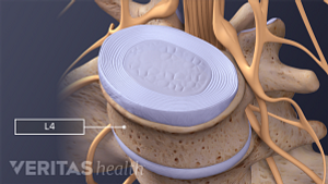 Medical illustration of a health L4 vertebra, the nerve root, disc nucleus and annulus are also labeled.