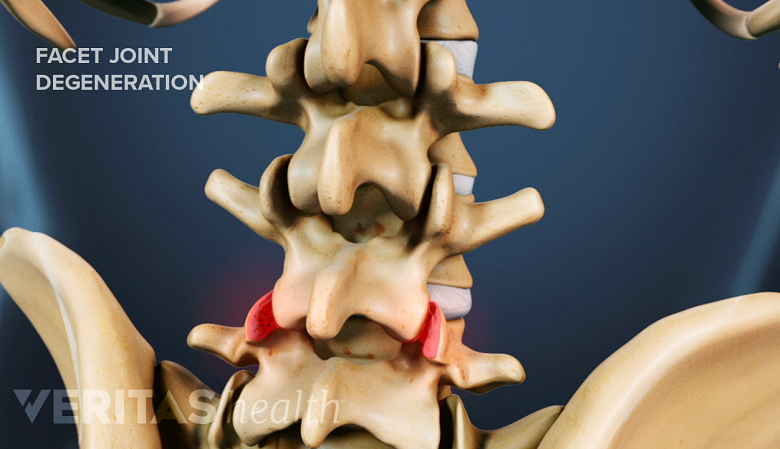 Illustration showing lumbar spine and pelvis with facet joints in red.