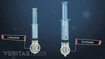 An illustration showing a syringe of liodcaine and second syringe of coritsone