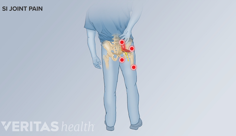 Illustration of the pain pattern and areas affected by pain in SI joint dysfunction.