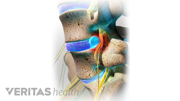 Una hernia discal en la columna lumbar.