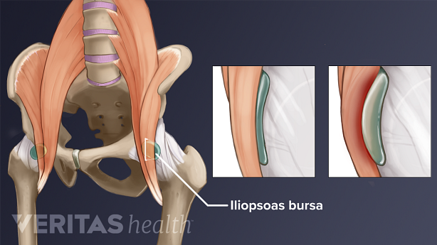 Anterior view of iliopsoas bursitis in the hip