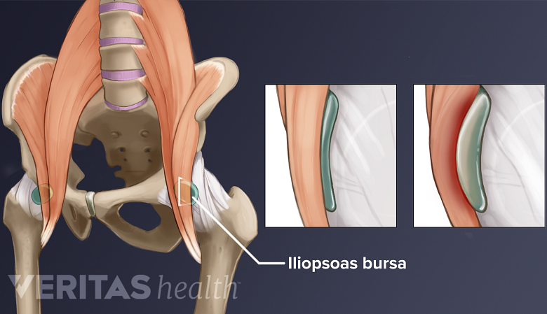 Illustration of the hips with an expanded section of a bursa.