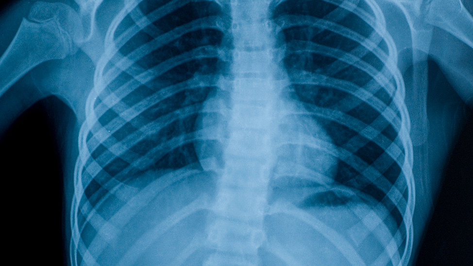 Anterior view of scoliosis on x-ray