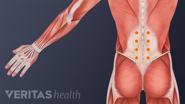 The needles used in percutaneous neuromodulation therapy are  arranged in pairs on either side of the spine and extend from the mid-back region down to the buttock. The number of needles is determined by the provider.