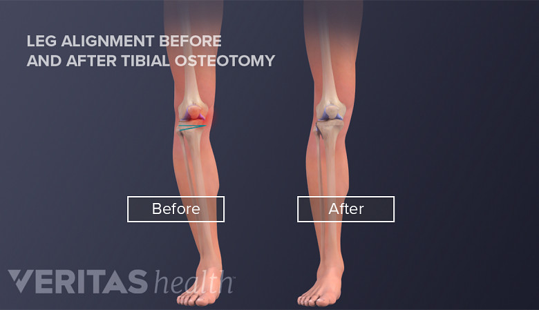Medical illustartion showing the leg alignment before and after a tibial osteotomy surgery. After the surgery there is less bowness in the lower leg.