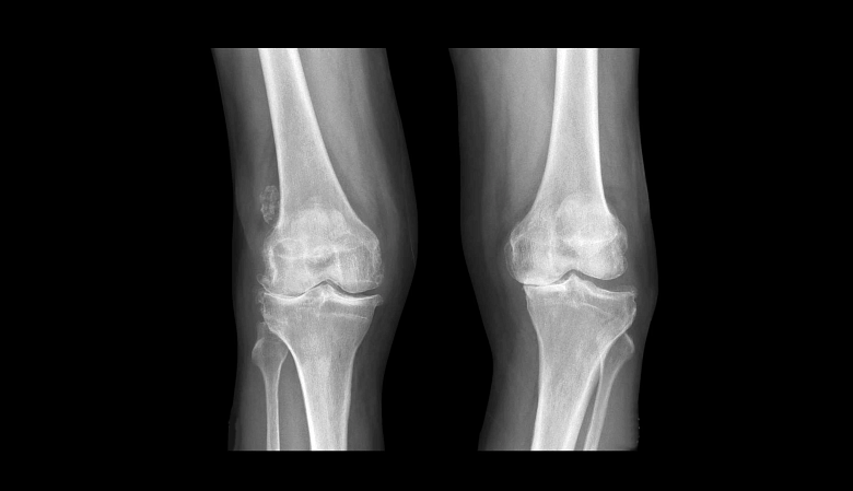 X-ray of the knees.