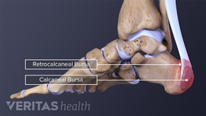 Medical illustration showing Retrocalcaneal and Calcaneal bursae in the heel of the foot