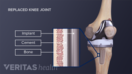 Medical illustration showing the femoral and tibial components of a knee replacement. Implant, cement and bone are labeled on an inset.