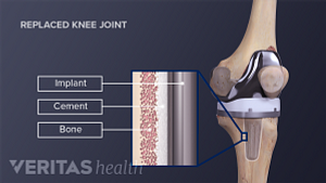 Medical illustration showing the femoral and tibial components of a knee replacement. Implant, cement and bone are labeled on an inset.