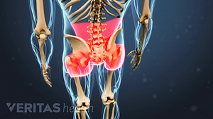 Illustrated skeleton highlighting pain in red in the buttock, lower back, and hips