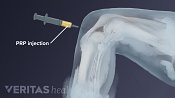PRP Knee injection illustration