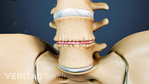 Anterior view of a degenerated disc in the lumbar spine.