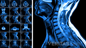 MRI of the cervical spine and the vertebral discs in different views.