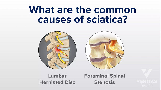 An image showing common causes of sciatica.