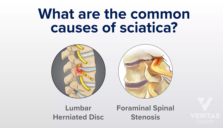 An image showing common causes of sciatica.
