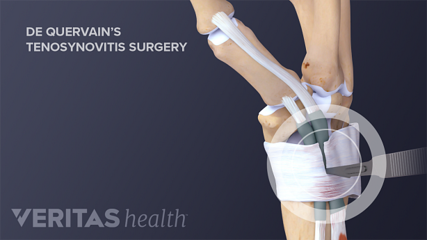 Incision from De Quervain’s Tenosynovitis Surgery