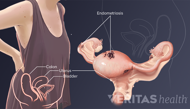 Medical illustration of endometriosis