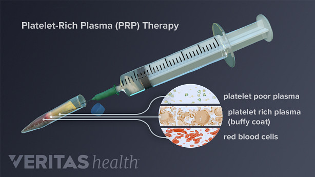 A syringe with a blood sample. Labels call out the different components: platelet-poor plasma, platelet-rich plasma (also called a buffy coat), and red blood cells