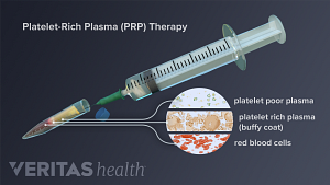 Medical illustration of the composition of a PRP injection