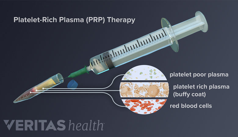 Illustration showing components of PRP injection.